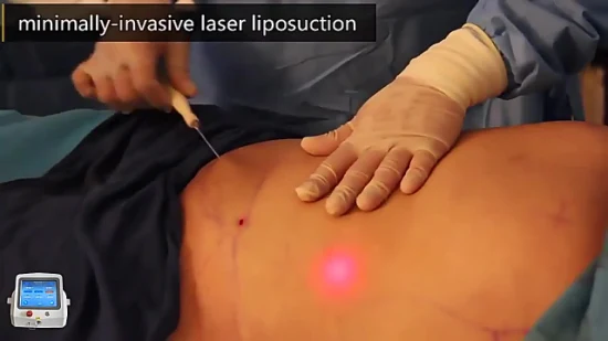 Ospedale mobile Triangl, attrezzatura medica, sala operatoria, unità chirurgica di liposuzione elettrica, aspirazione a vuoto, lipolisi laser, macchina lipolaser, 980 nm, 1470 nm