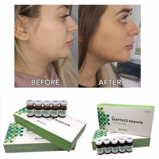 Liposonix portatile caldo per perdita di peso verticale Hifu Ultrashape