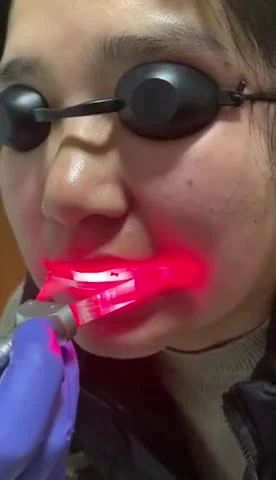 Dispositivo dentale laser a diodi per sbiancamento dei denti approvato CE per parodontite