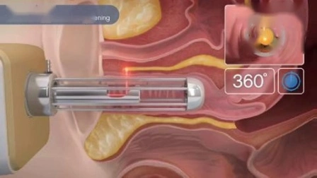 Tubo RF in metallo, rimozione delle smagliature, rassodamento vaginale, laser CO2 frazionato, laser CO2 frazionato, rassodamento vaginale, ringiovanimento della pelle, laser CO2 frazionato